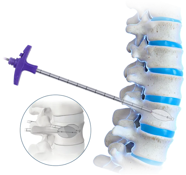 Kit para Cifoplastia con Balón