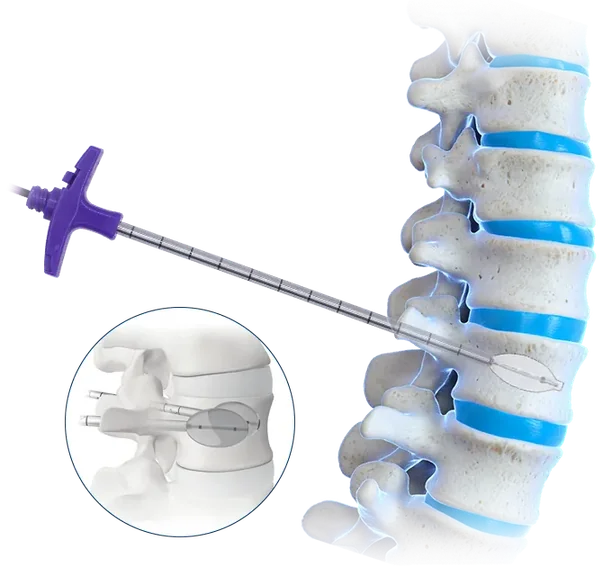 Kit para Cifoplastia con Balón